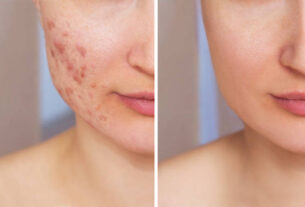 4 skin care for acne scars for dark spot according to dermatologist english.hapekit.com